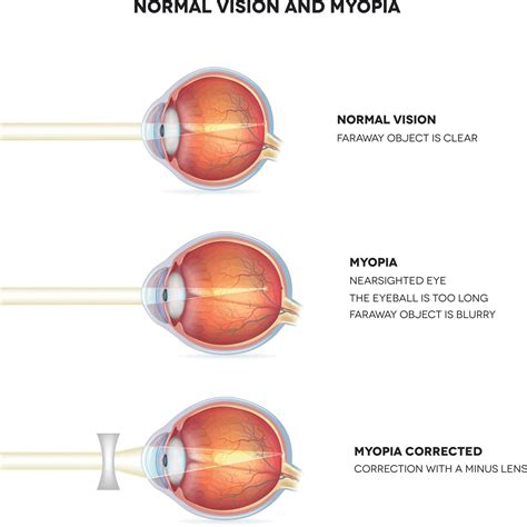 What is Myopia? (Nearsightedness): Symptoms & Treatment