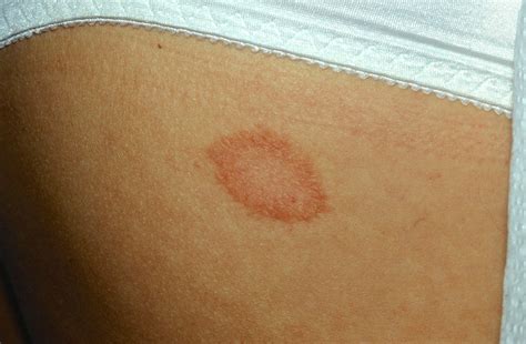 Pityriasis Rosea Causes Rash Herald Patch Stages Treatment