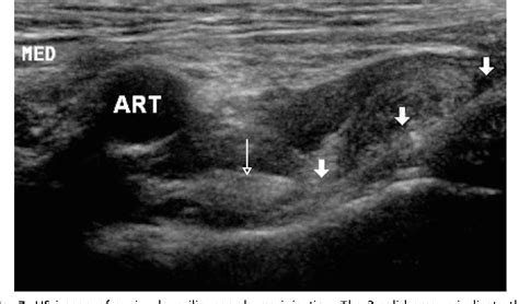 Ultrasound Guided Hip Injection