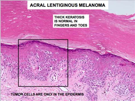 Acral Lentiginous Melanoma Histology