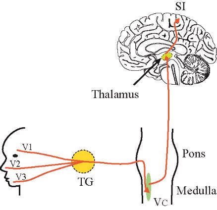 Trigeminal pain pathway. Pain sensation from face and mouth is carried ...