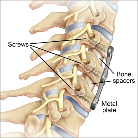 Neck Surgery C5 C6 C7 Recovery Time | Renew Physical Therapy