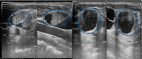 Thyroid Ultrasound