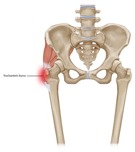 Trochanteric Bursa Injection | Chronic Pain Treatment | Pain Spa ...