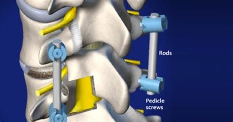 Transforaminal Lumbar Interbody Fusion (TLIF) - Atlanta, GA - Spine Surgery