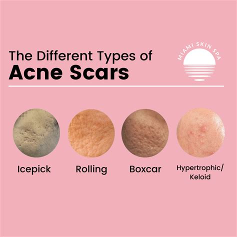 Types of Acne Scars: Pictures, Diagnosis and Treatments