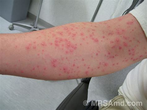 rashes after tattoos - pictures, photos