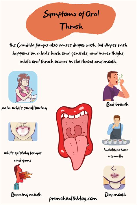 Oral thrush symptoms causes and treatment – Artofit