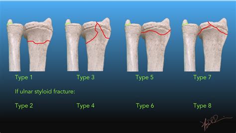 Frykman Classification of Distal Radial Fractures | UW Emergency Radiology