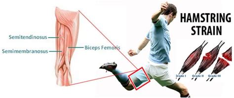 Pain-Free Physiotherapy for Hamstring Strains in Delhi