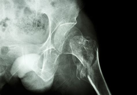 Second hip fractures account for one-in-10 hip fracture surgeries - APFFA