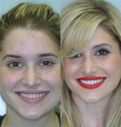 Before & After Porcelain Veneers - Cosmetic Dentists of Houston ...