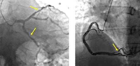 Figure 5 from Wellens’ Syndrome: Focus on Diagnosis and Choice of ...