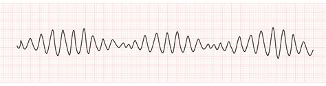 EKG Monitor Showing Polymorphic Ventricular Tachycardia Or VT Torsades