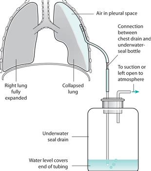 12. Chest Drainage: Underwater Seal or Chest Drainage System | Nurse Key