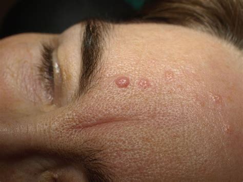 Facts About Seborrheic Keratosis - San Antonio & Boerne Dermatologist