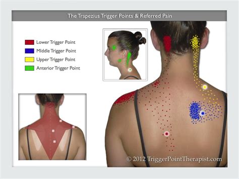 Trapezius Trigger Points Are Like Opinions, Everyone Has One ...