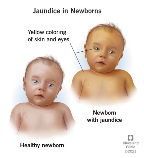 Jaundice in Newborns: Symptoms, Causes & Treatment