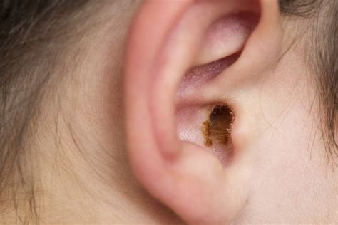 What Causes Dry Ears? - Open Web Portal