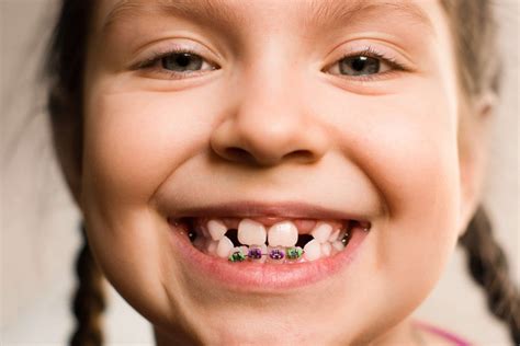 Orthodontic treatment: Why and how teeth move? - Wilmington Orthodontic ...