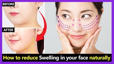 Perfect Info About How To Reduce Swollen Face - Horsebud99