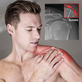 What Causes Shoulder Bursitis And How To Fix It – Doctor Identity Services