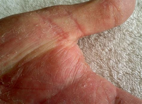 Hand Fungus - Pictures, Symptoms, Treatment and Causes - (2018 - Updated)