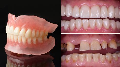 Dentures Before And After Pictures | What To Expect