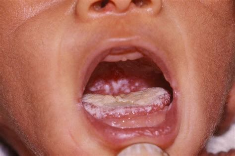 Oral Thrush Not Responding To Nystatin