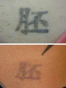 Fading Fast - Laser Tattoo Removal and Fading Specialist