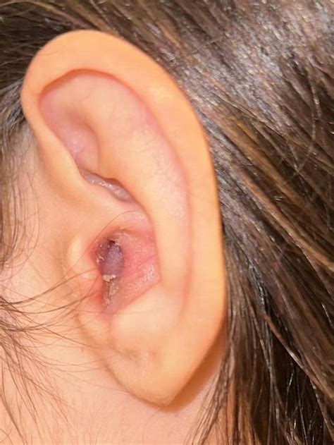 dry flaky skin in ear canals : r/medical_advice