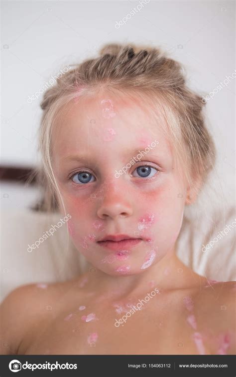 The cute little girl is sick with chickenpox. The face is covered with ...