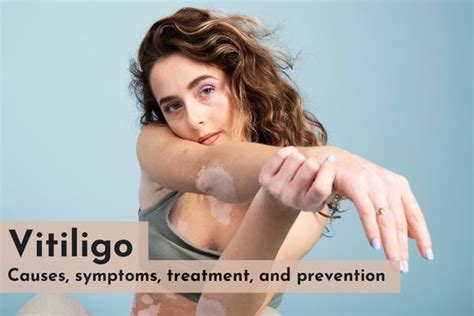 Vitiligo: Causes, symptoms, treatment, and prevention - SkinQure