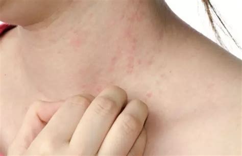 Eczema - Symptoms and Causes - America's Best Care Plus