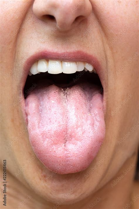 Candidiasis on female tongue Stock Photo | Adobe Stock