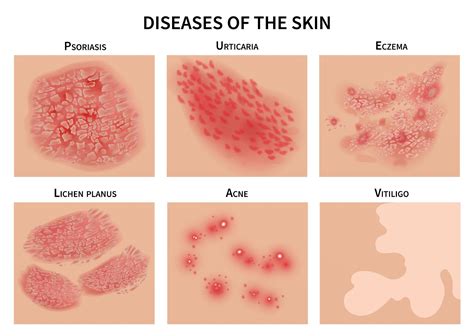 How to tell the difference between eczema and psoriasis, so you can get ...