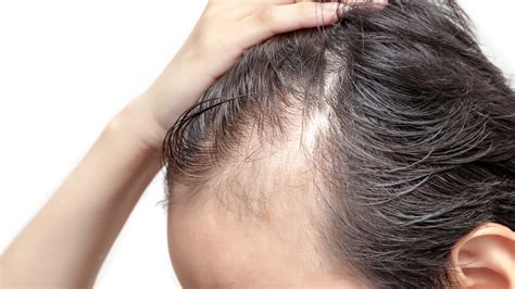 What is Frontal fibrosing alopecia | Trichology