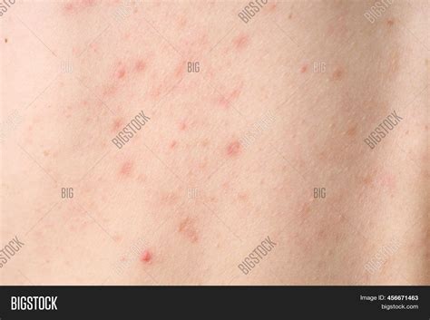 Skin Acne, Red Spots. Image & Photo (Free Trial) | Bigstock