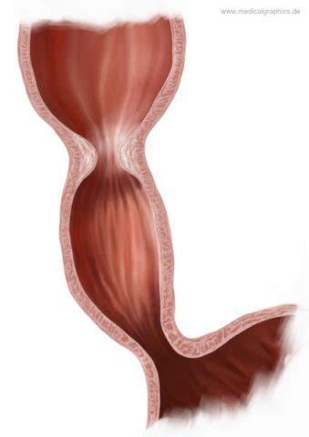 Free Illustration Esophageal stricture