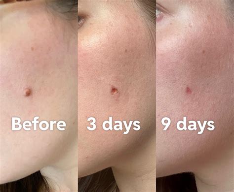 [Before & After] Mole removal edition! : r/SkincareAddiction