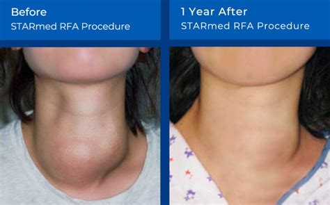 Thyroid Nodule RFA - Los Angeles CA | CVI Thyroid Center