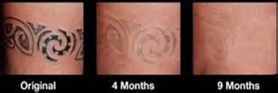 Laser Tattoo Removal Course | Tattoo Removal Machine | ATSCI