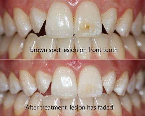 White and brown spots on teeth | Other Northcote VIC