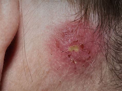 Staph infection: Types, symptoms, causes, treatments