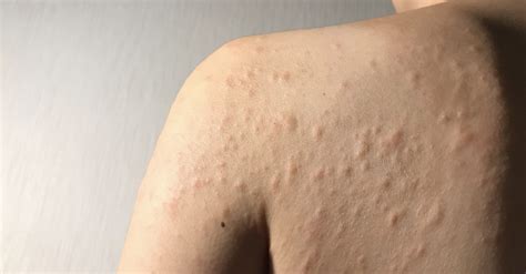 Urticaria and Other Skin Allergy | Allergy UK | National Charity