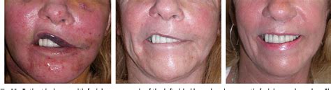 Figure 4 from Complications in facelift surgery and their prevention ...