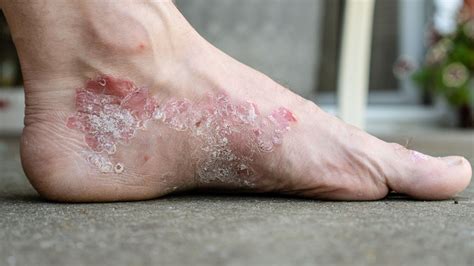 Eczema vs. Psoriasis: Similarities, Differences and Treatments