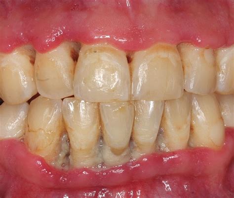 Necrotizing Ulcerative Gingivitis Before And After