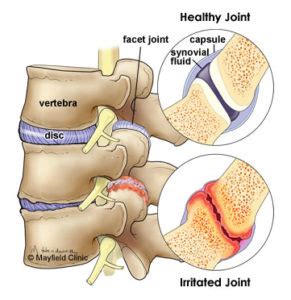 Facet Arthritis Treatment in Dallas, Texas