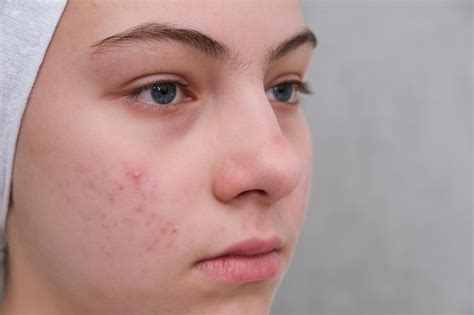 Premium Photo | Acne Teenage girl with the pimples on her face ...